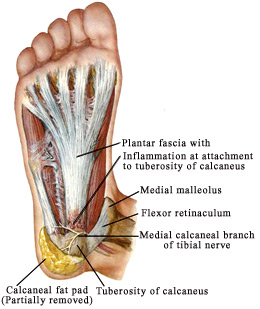 Posterior Calcaneal Spur